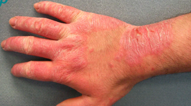 La Roncha Endemoniada.